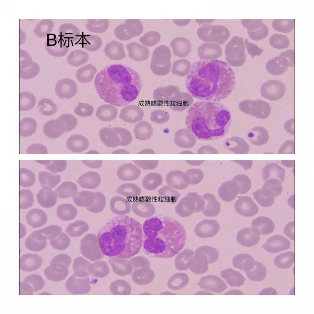 c标本中有少量幼稚嗜酸性粒细胞,镜检结果如下