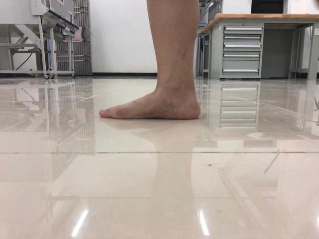 扁平足是低弓足的一种,是指先天性或者姿势性因素导致足弓过低或者
