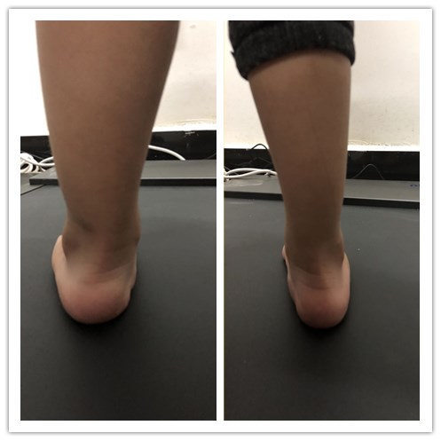 扁平足的康复神器:矫形鞋垫治疗_腾讯新闻