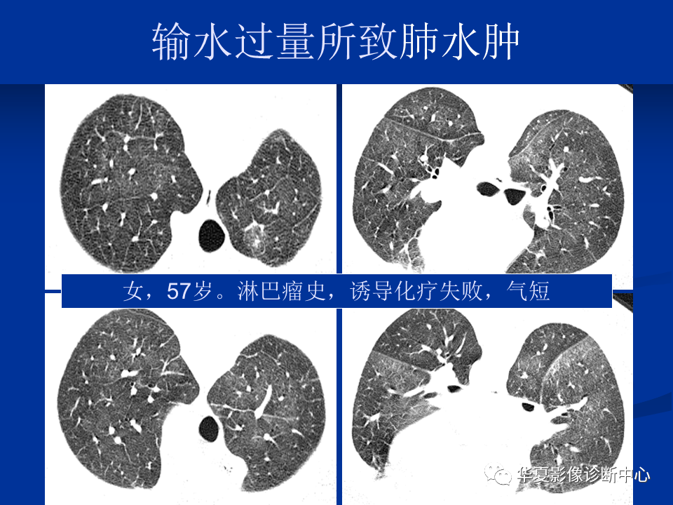 不同類型肺水腫的ct表現