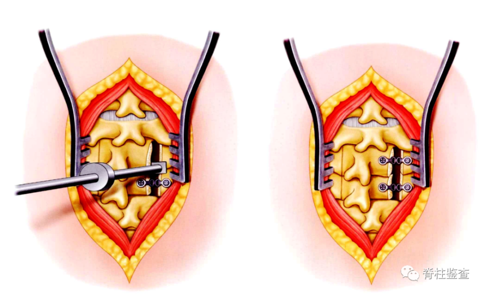 与颈椎椎板切除术相比,clp在提供多节段减压的同时能够保留后柱结构