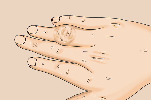 五十岁上下的女性,一早醒来手指僵硬,疼痛动不了,这是咋了