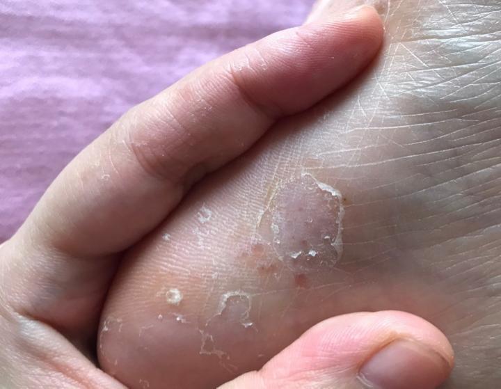 长春肤康医院浅谈:脚气都有哪些类型?其症状又有哪些?