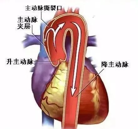 而主动脉夹层的形成是由于血流撕开了血管内膜,进到中膜,进而冲破外膜