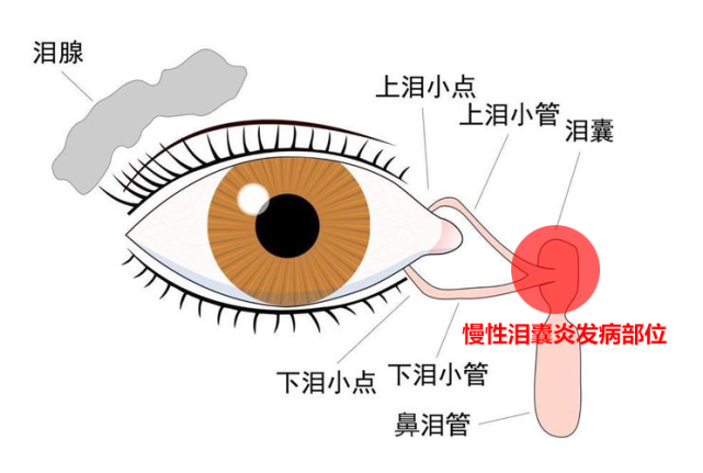 莫名流淚1年還流膿,原來眼睛裡的淚囊也會發炎