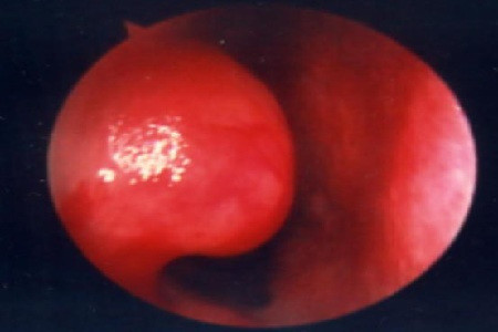 下鼻甲肥大的临床表现