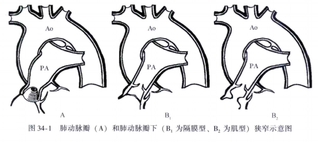 筆記分享:肺動脈狹窄