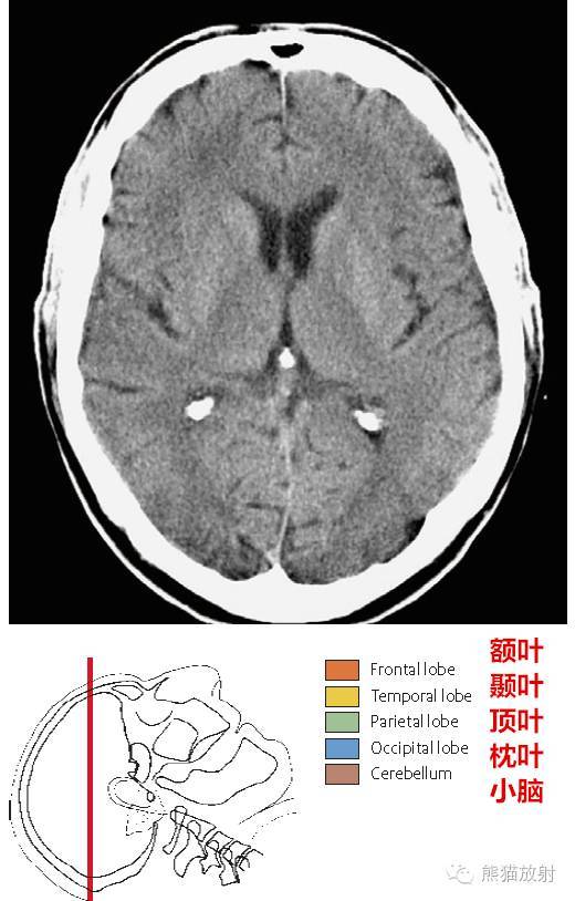 【解剖】顱腦ct斷層(中英文對照乾貨滿滿)
