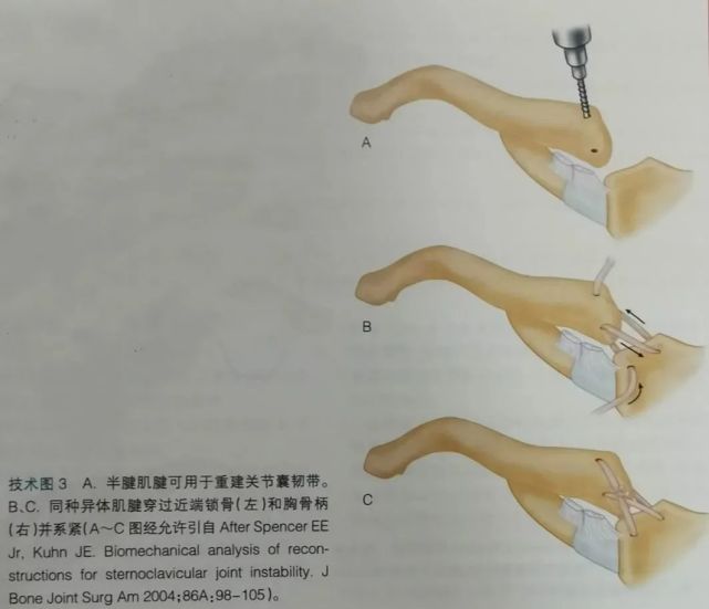 手术技巧胸锁关节脱位的早期修复和重建