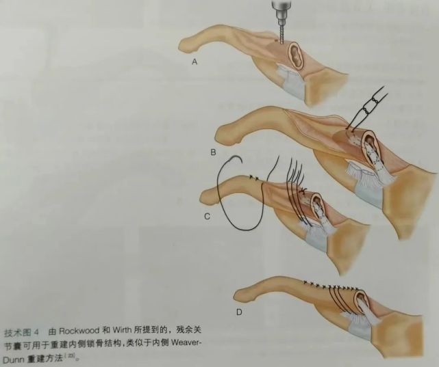 手术技巧胸锁关节脱位的早期修复和重建