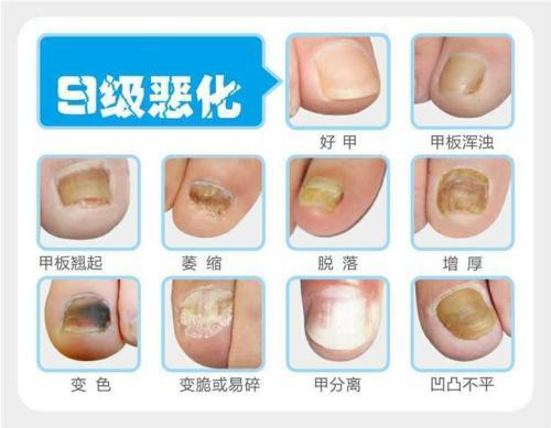比大蒜还有效的祛灰甲神器最短一个月消除灰指甲症状消除增厚不复发