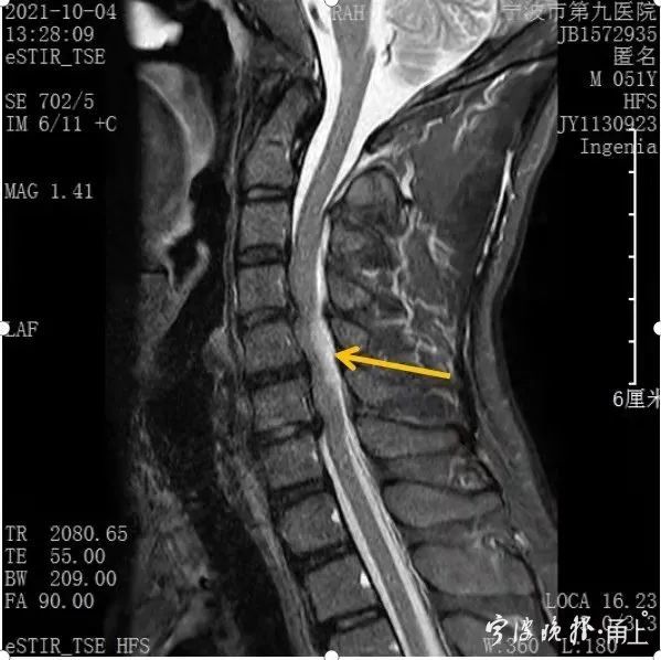 脊髓损伤磁共振图片