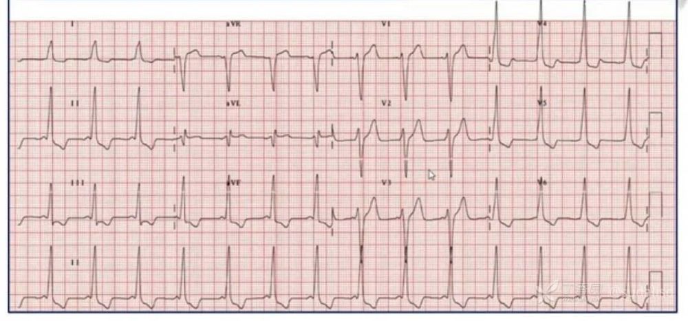 8個預激綜合徵心電圖看完對旁道迷路不再困惑