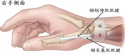 腱鞘炎的症狀及治療方法