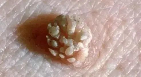 女人感染了hpv,一定是老公出轨了吗?