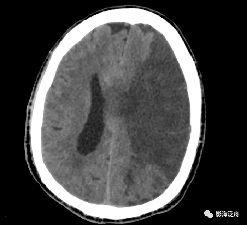 【夜班不求人】急性腦梗死的ct診斷_騰訊新聞
