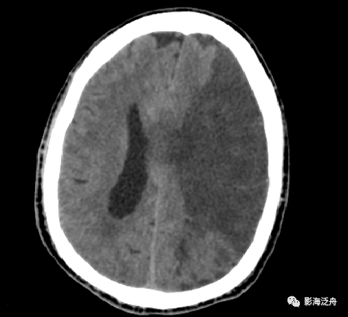夜班不求人急性脑梗死的ct诊断