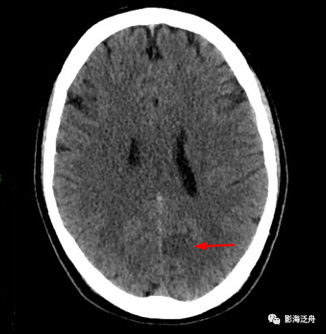 脑干梗死CT图片