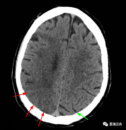 进一步引起细胞毒性脑水肿会使病变区域的脑沟,脑裂变浅和消失,ct平扫