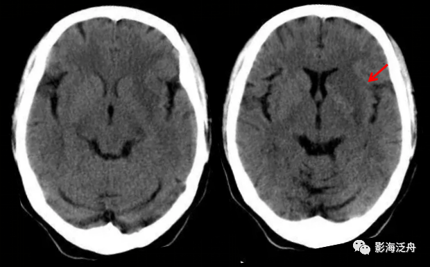 【夜班不求人】急性腦梗死的ct診斷_騰訊新聞