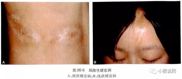 (1)斑块状硬皮病:又称硬斑病,好发于成人,躯干部多见,但亦可发生于