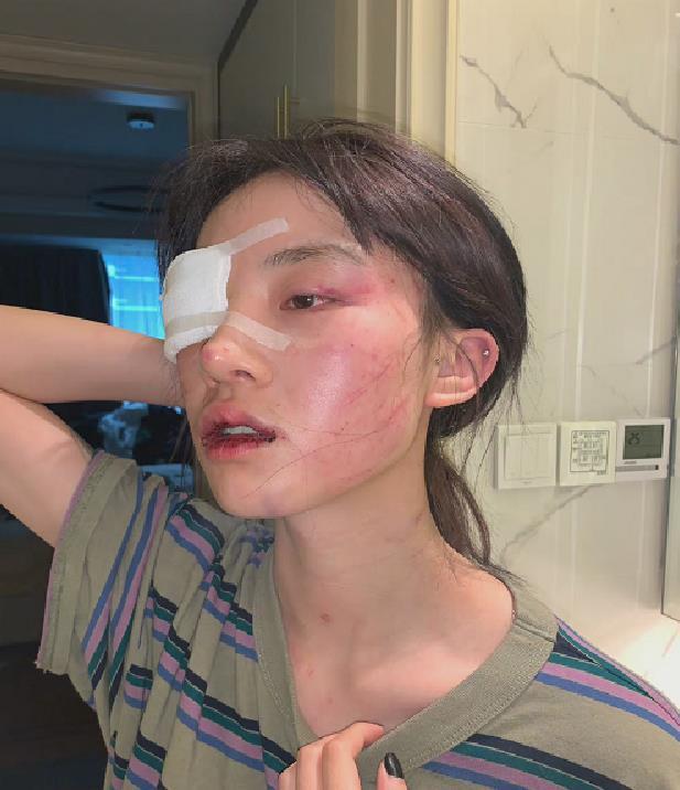 猪有蹄被男友家暴打伤后,王多鱼也相继被打伤,晒受伤照怒斥渣男