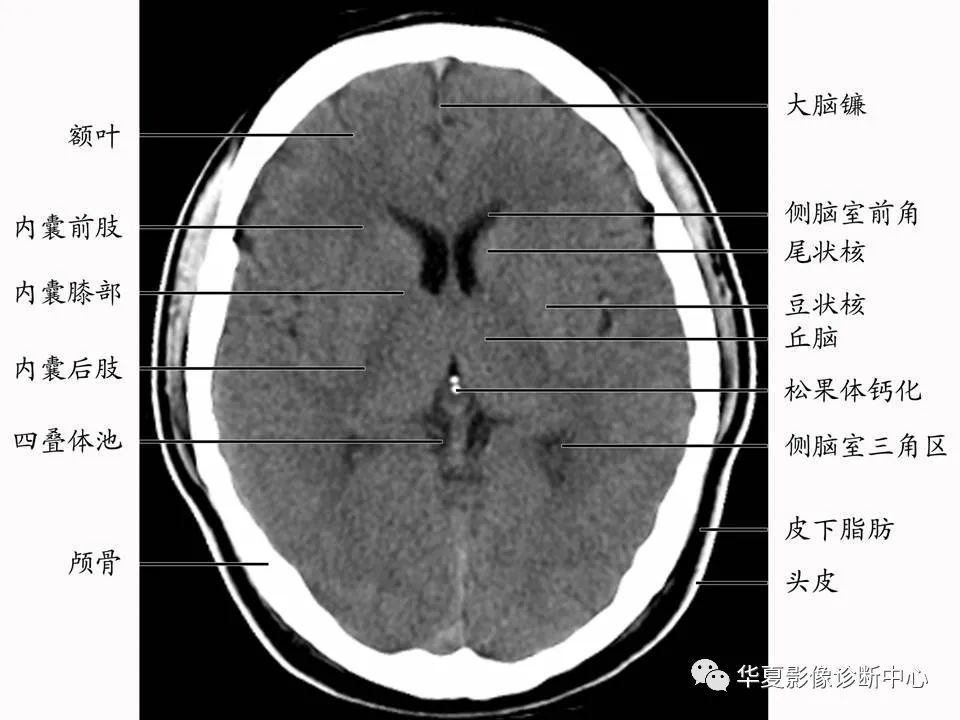 基底节深部核团疾病的诊断与鉴别诊断