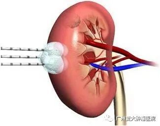 十年腎癌患者,為避免開刀三顧廣州復大