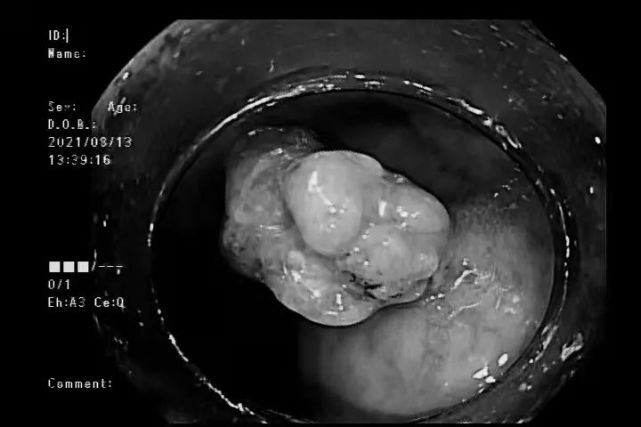 21岁小伙确诊直肠癌晚期癌症离你到底有多远