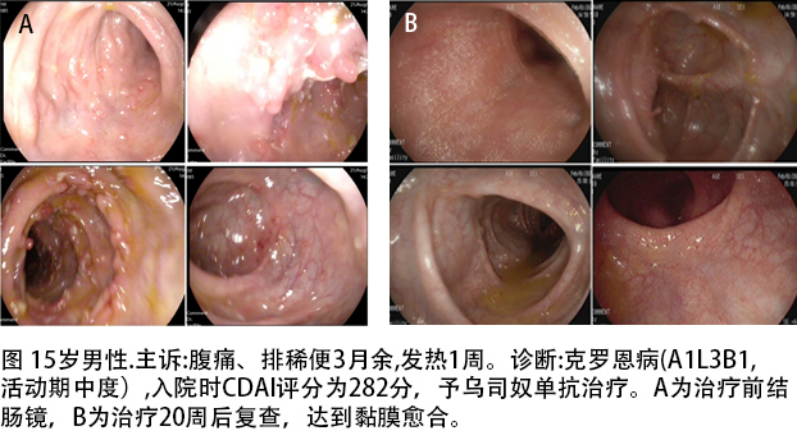 烏司奴單抗治療克羅恩病中國醫科大學附屬盛京醫院田豐教授團隊23例