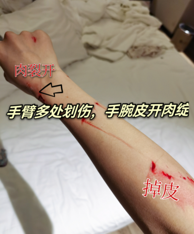女星酒店洗澡遇玻璃炸裂,胳膊被大面积划伤全是血痕
