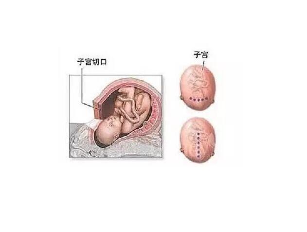 不完全性子宫破裂图片