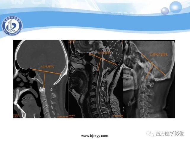 顱底凹陷症的影像診斷