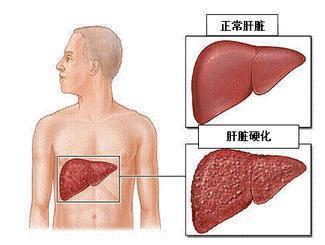 肝疼有什么症状图片