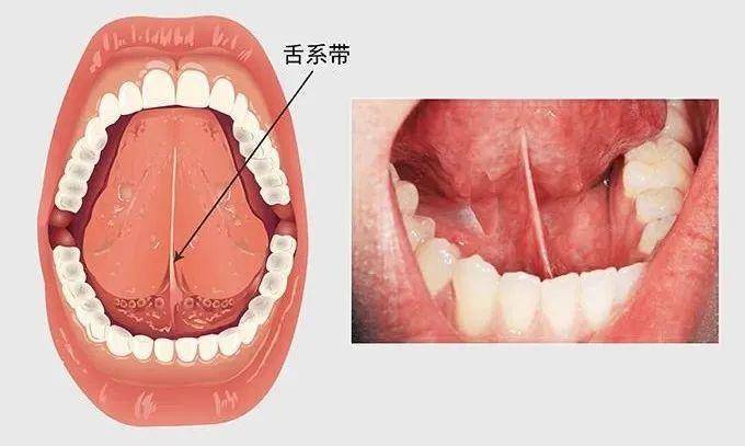 舌系带过短是先天性发育性疾病,属于发育性异常,是舌系带附丽于舌腹部