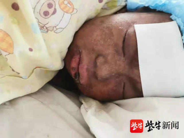 中国人白化病图片儿童图片