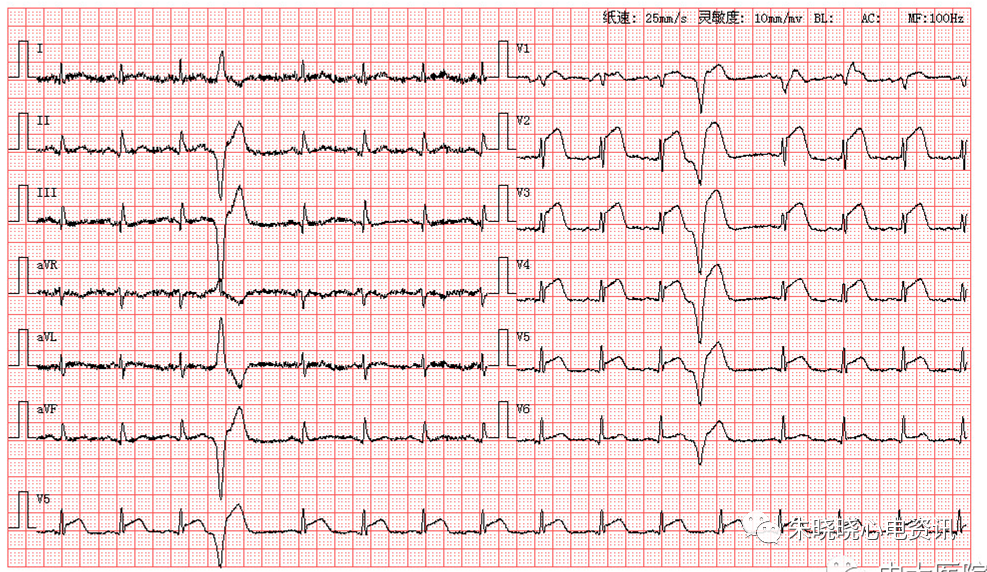 每日读图第1539期室性早搏急性广泛前壁心肌梗死