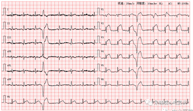 每日读图第1538期室性早搏呈三联律