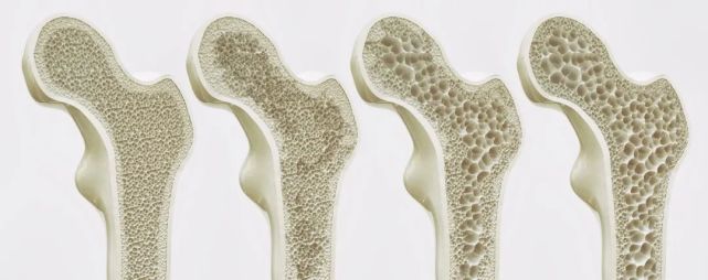 骨质疏松为什么偏爱女性?