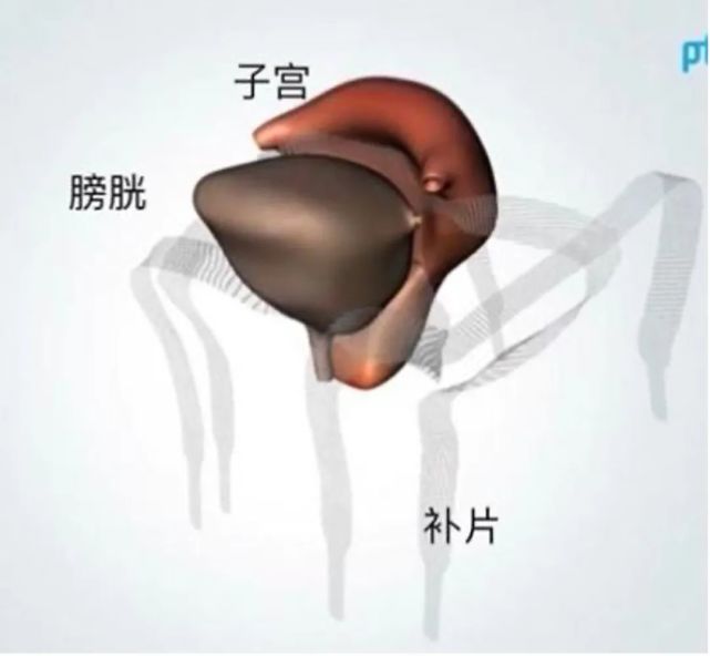 用"补片材料"缝缝补补,可以矫正盆腔脱垂器官的异常位置,减轻盆底肌的