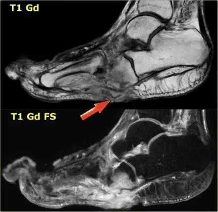 一文掌握|糖尿病足mri