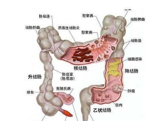 直肠癌为肛管齿线至乙状结肠与直肠交界处之间的癌,是消化道最常见的