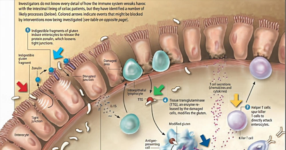 連蛋白zonulin有什麼用連蛋白zonulin和腸漏麩質過敏的關係