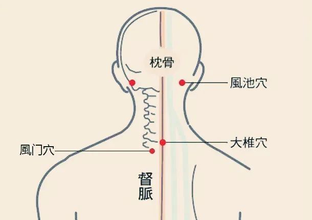 取砭板在50℃熱水中浸1分鐘,由腰部大腸俞(當第4腰椎棘突下,旁開1.