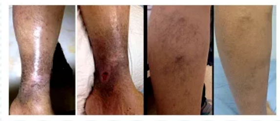 静脉曲张4-6小时出院 哈医大四院血管外科引入快速微创治疗新理念