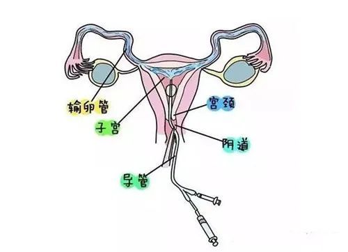 女性附件在哪个位置图片