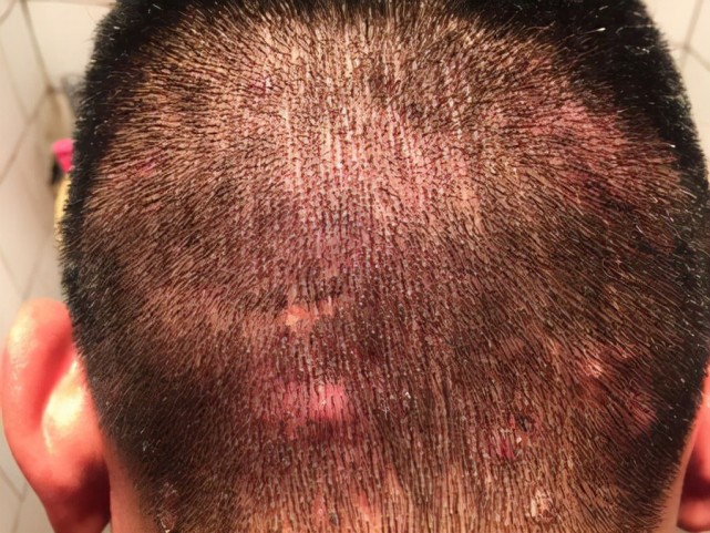 头上总是长疙瘩还时不时有脓包很可能是这4种现象引起的