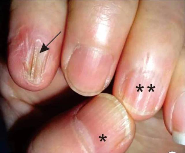 偶买噶我的指甲为什么总也治不好4种甲病要对症治疗