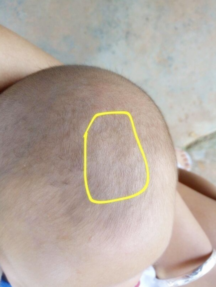 2)凹陷正常的囟门是平着的,并且会随着心脏的跳动而不停地跳动.