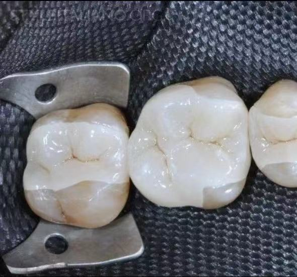 科普丨嵌体的临床应用_腾讯新闻